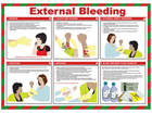 External bleeding treatment guide.